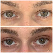 Under Eyes (UPPER FACE)
