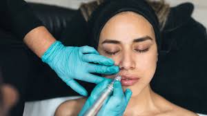 LIP FILLER - Hyaluronic Acid Filler