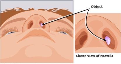 nasal foreign body