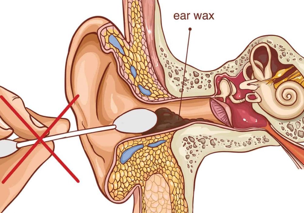 Ear Wax Removal per Ear