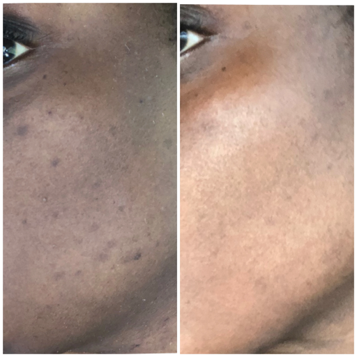 Deep peel (Fall/Winter season Only)