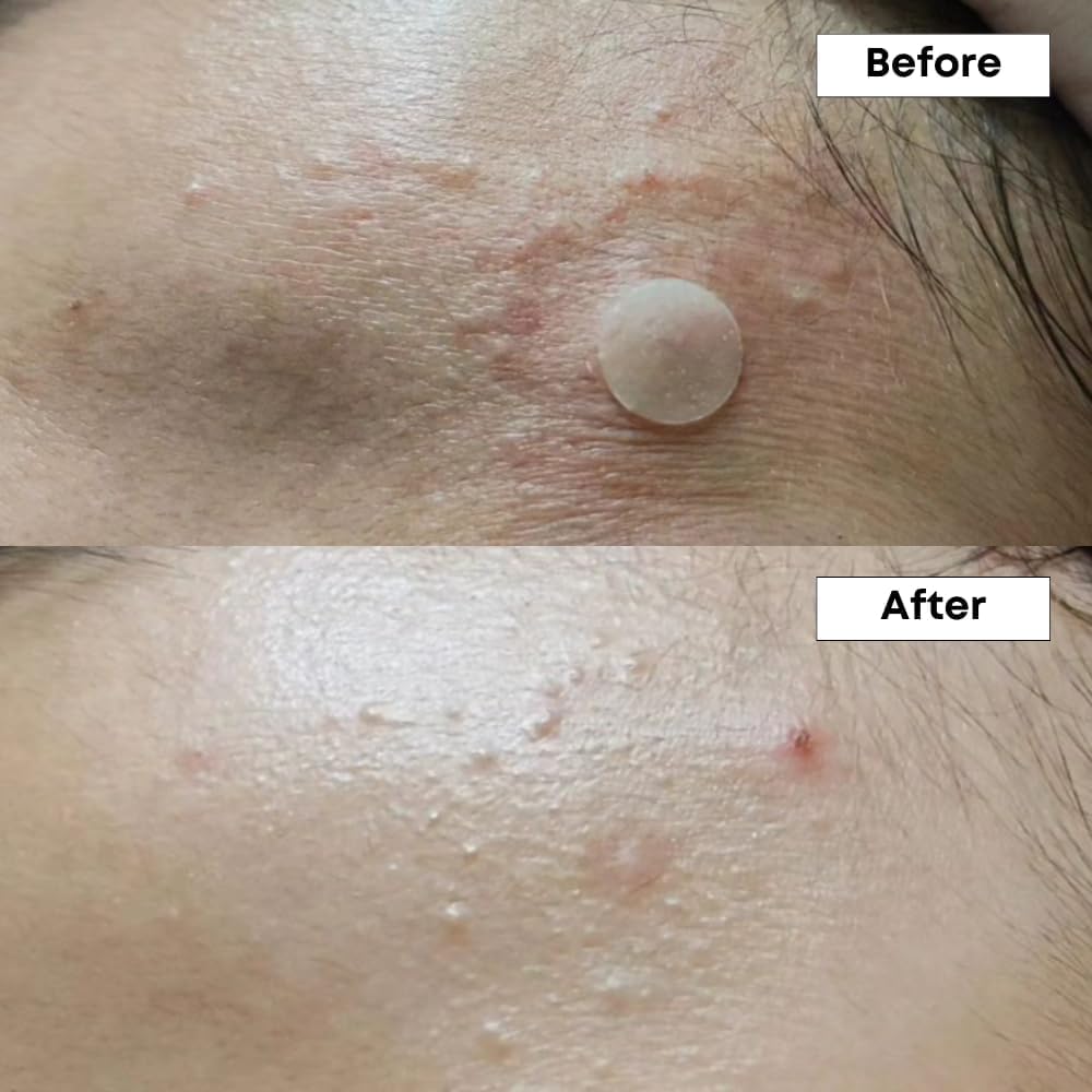 Nineless Azelaic Acid A-Control 10% Serum for Unisex, Oily, Combination