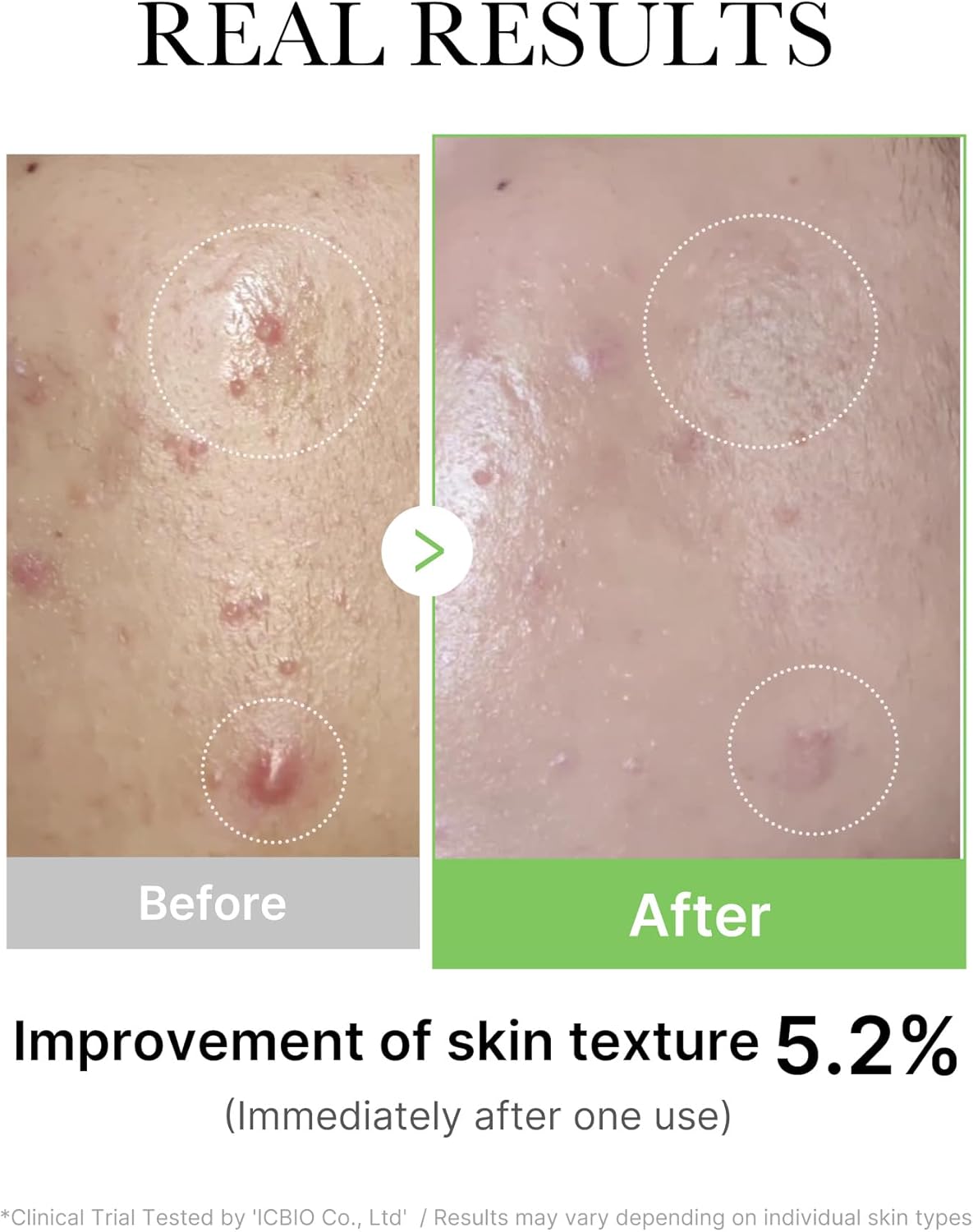 Medicube Tea Tree Exosome Cica Ampoule for Sensitive Skin helps reduce redness and rashes. 30 ml