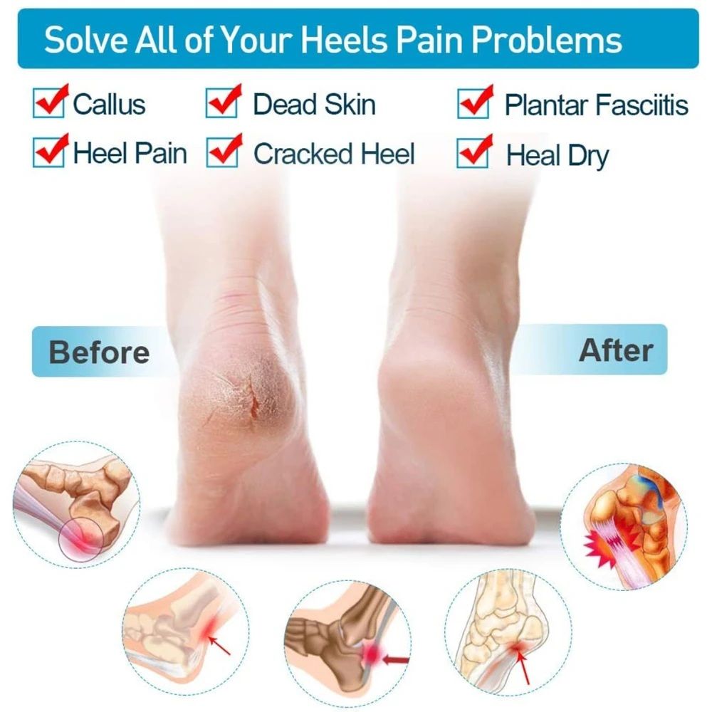 "Silicone Heel Protectors & Anti-Crack Care Set