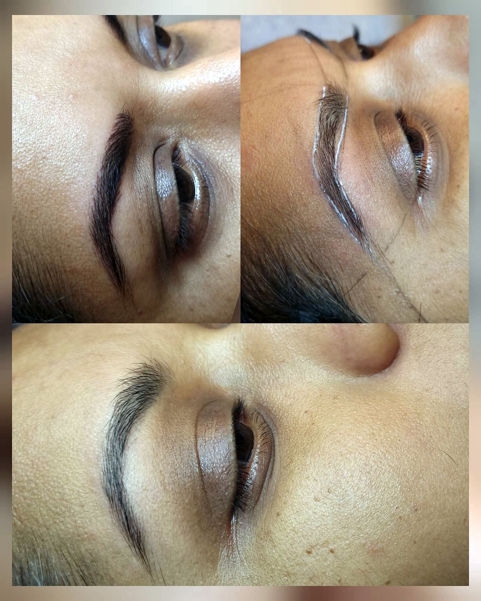 מיקרובליידינג לגבות