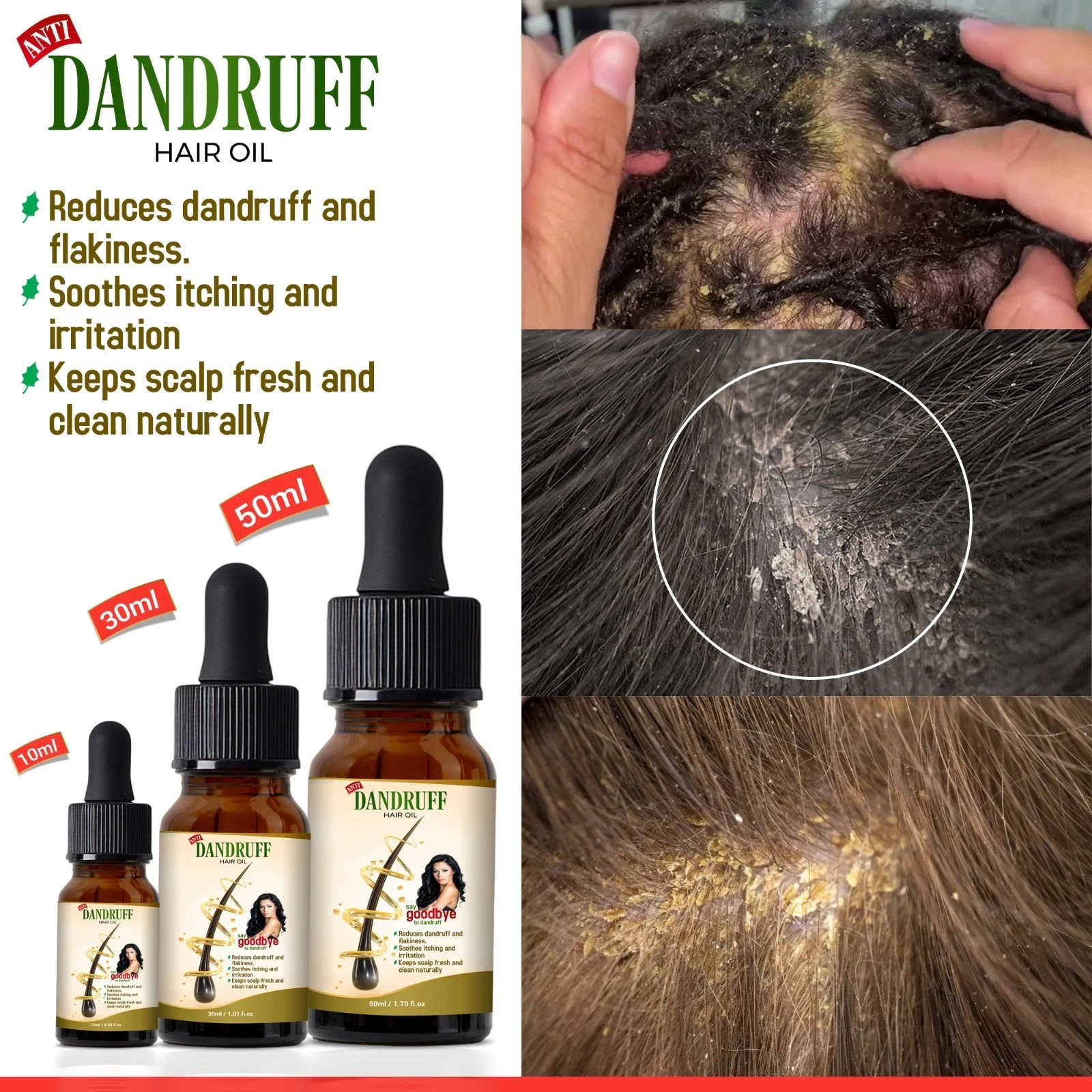 Dandruff Hair Oil Natural Scalp Treatment Nourishing Oil for Dry Scalp UK