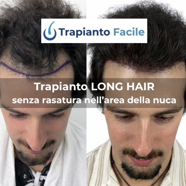 Blocco Trapianto con Tecnica DHI LONG HAIR