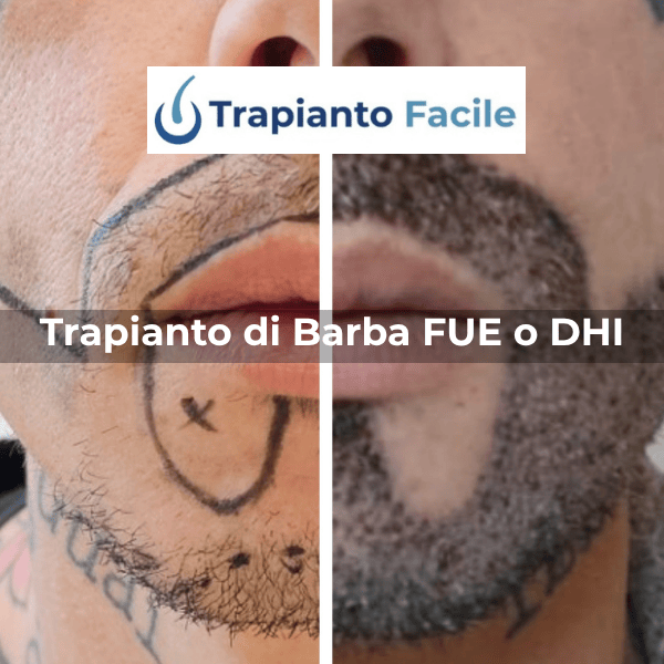 Blocco Trapianto di Barba con Tecnica FUE o DHI