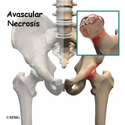 Necrose avascular da cabeca femoral