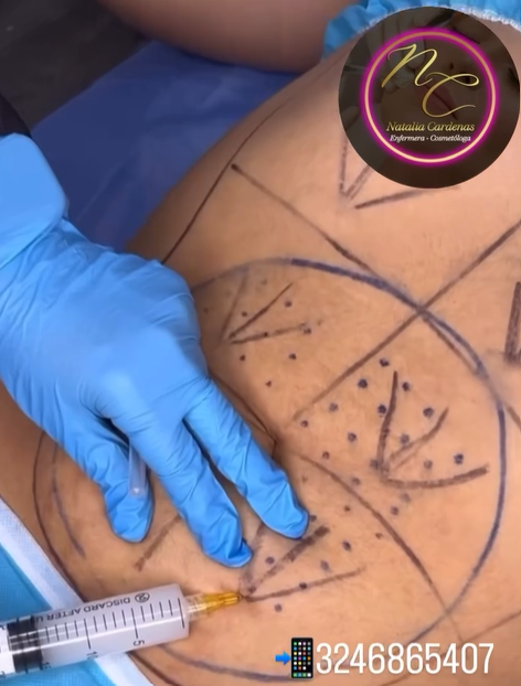 HIDROLIPOCLASIA BASICA