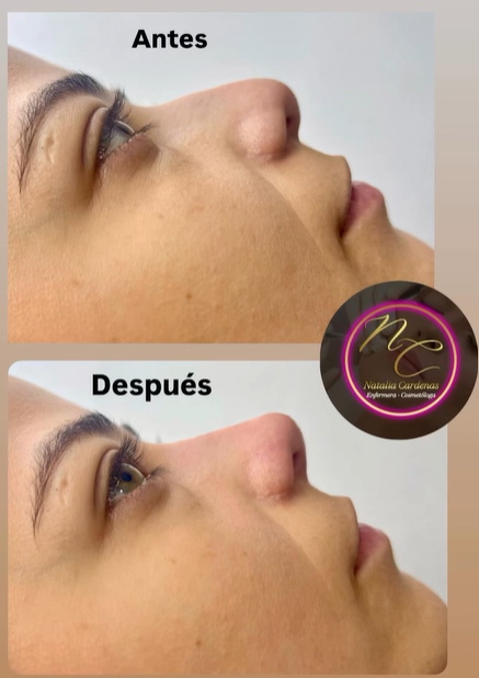 Rinoplastia De Nariz