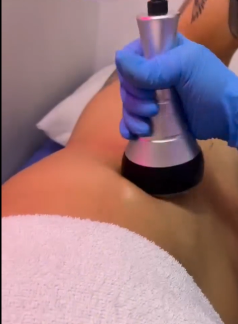 Cavitación y Radiofreciencia