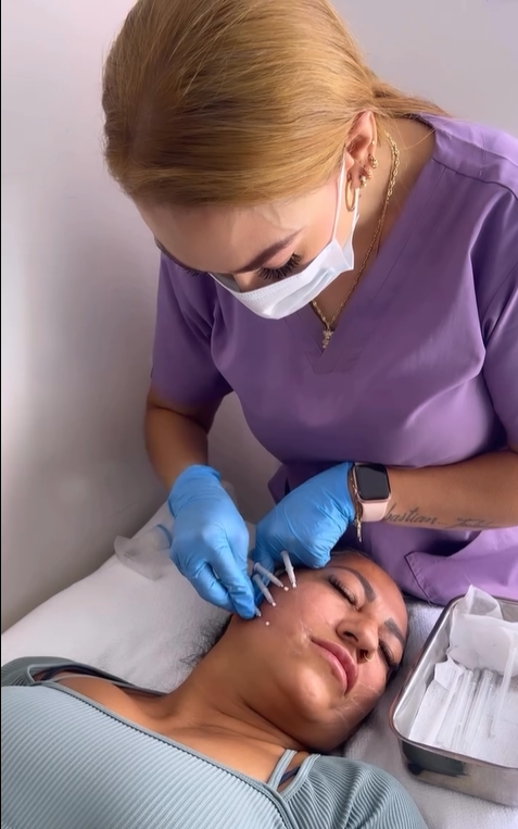 Hilos lisos (colágeno)