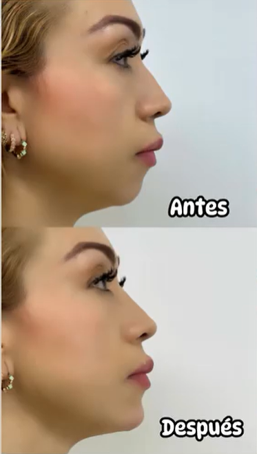 Ácido Hialurónico En Mentón