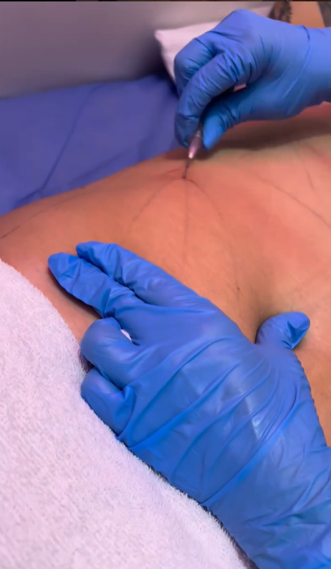 Hidrolipoclasia Con Microcanula