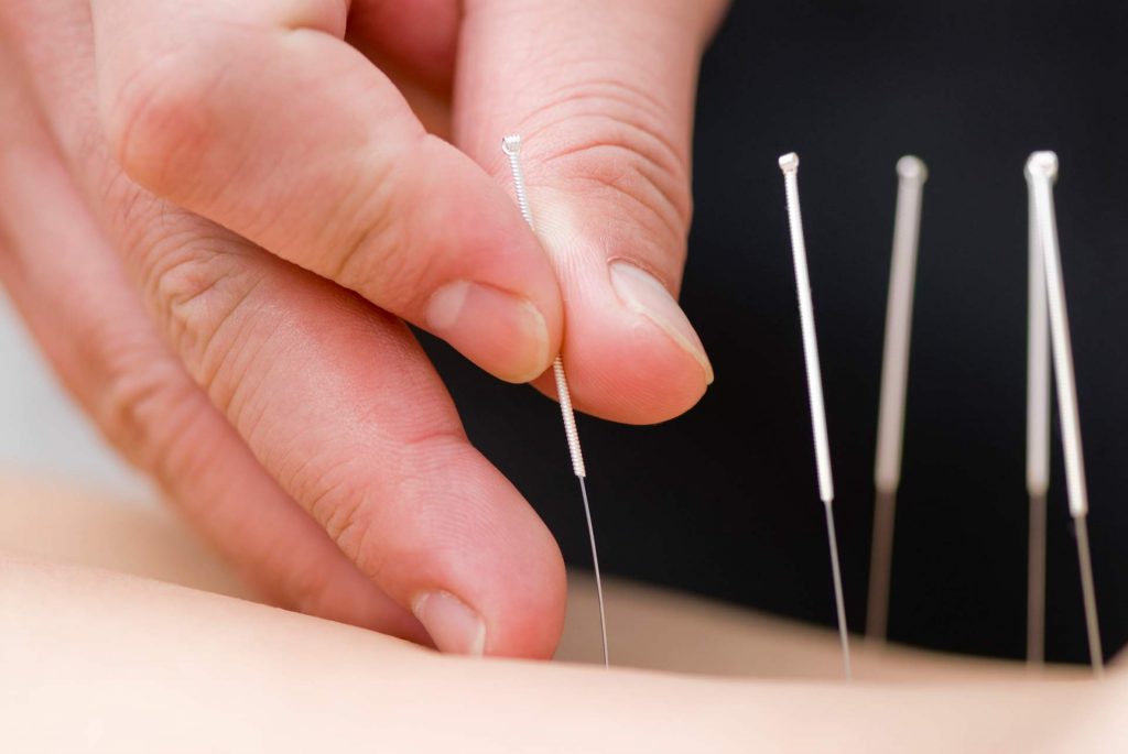 Acupuncture Needles