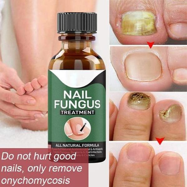 Fast Nail Fungal Treatments Nail Repair