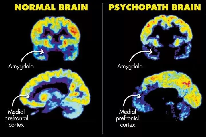 New Study Reveals How Psychopath Brains Differ From Normal