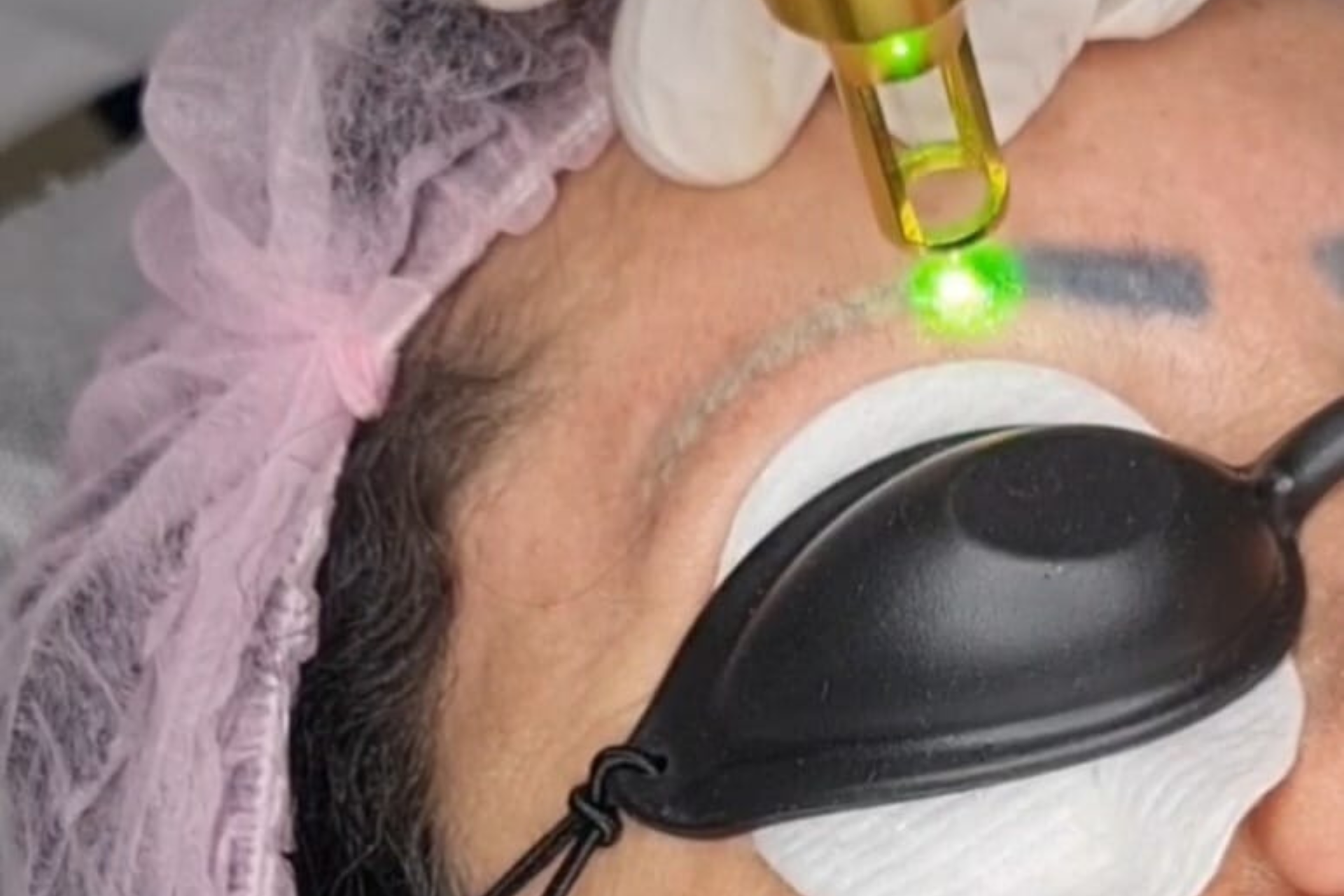 Remoção de Micropigmentação + Peeling de Carbono