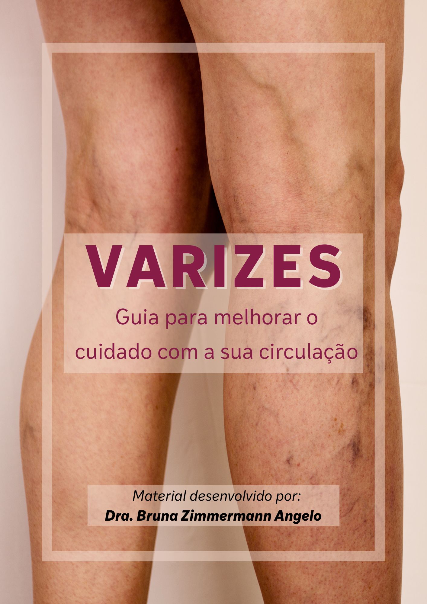 E-Book Varizes - Guia completo