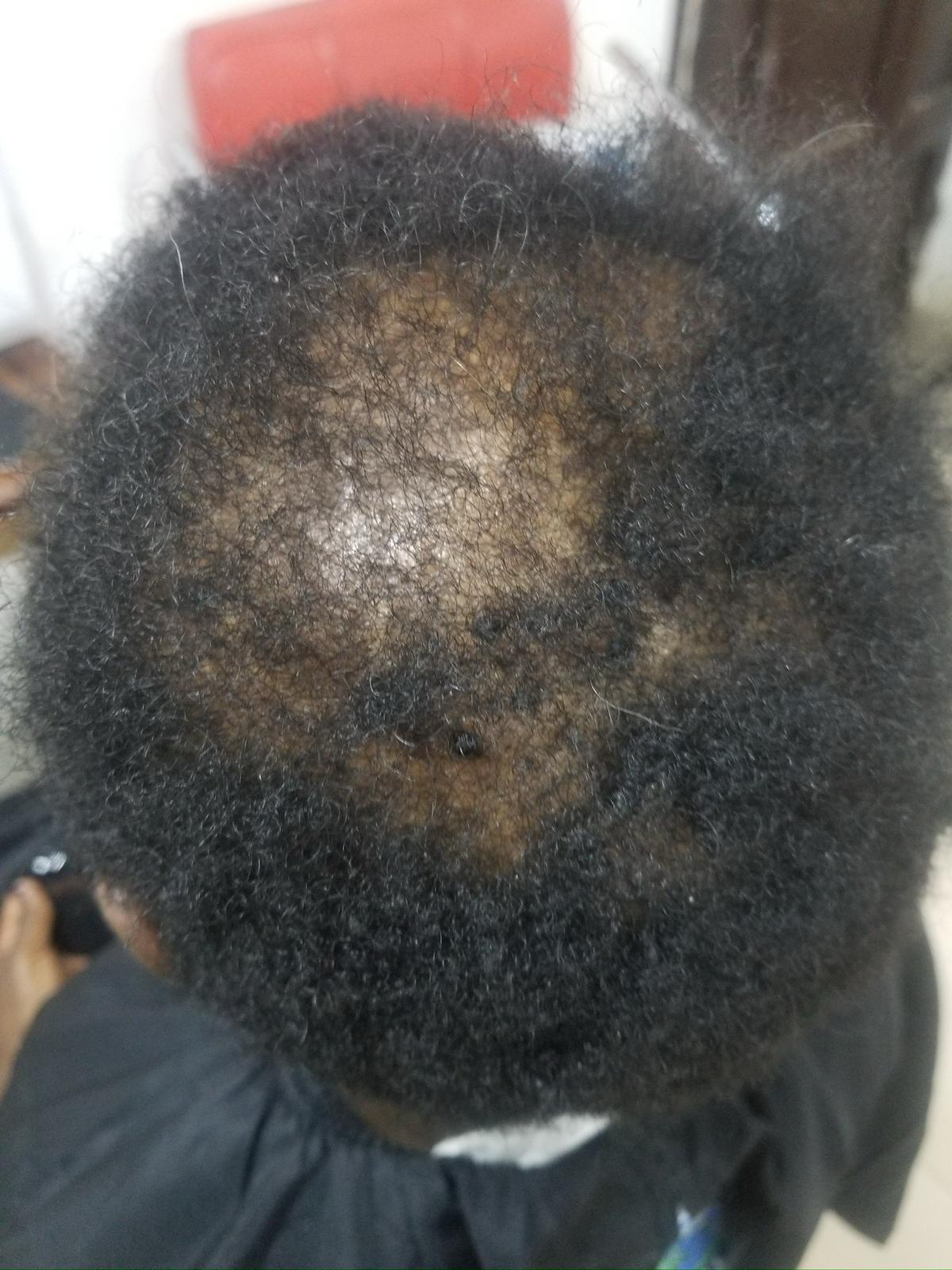 Hair Loss Consultation