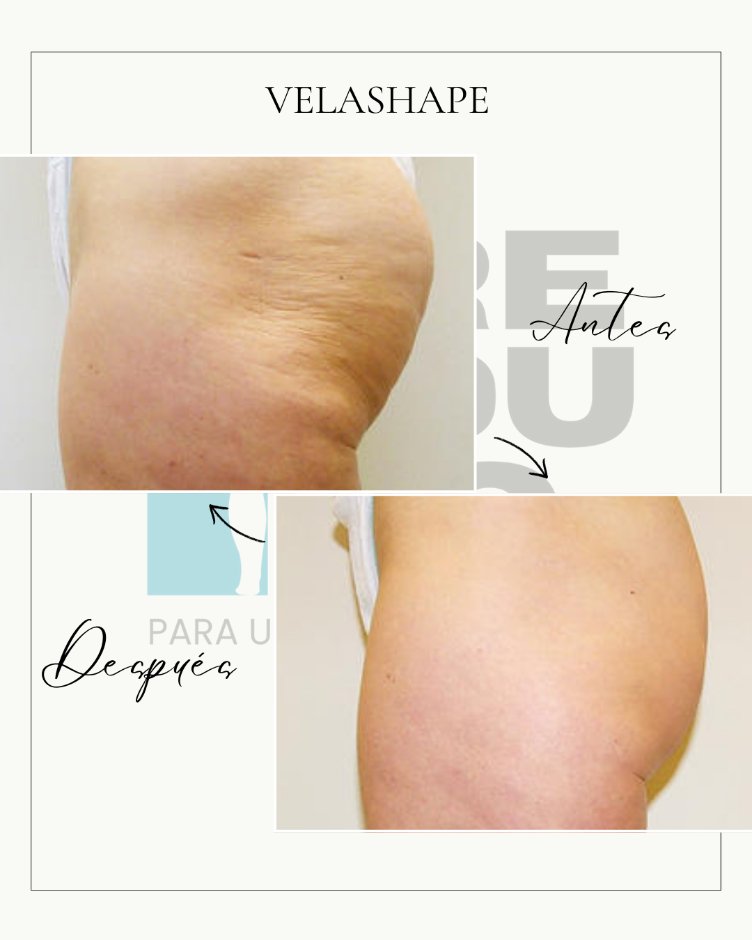 Velashape (5 sesiones)