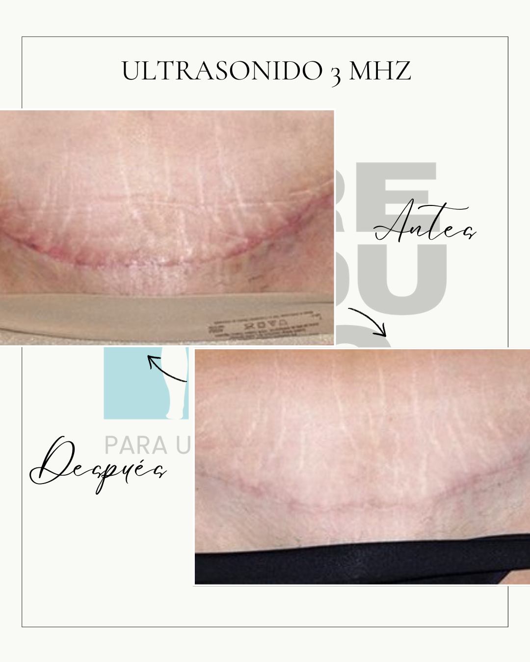 Pack POST-OP RECOVERY ELITE