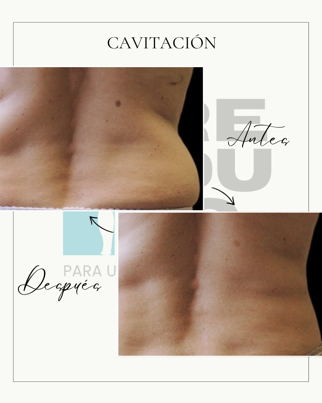 Cavitación (5 sesiones)