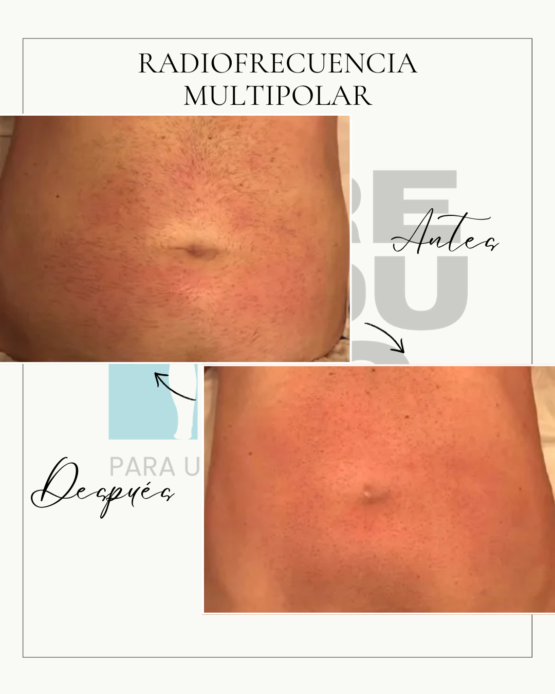 Pack POST-OP RECOVERY ELITE