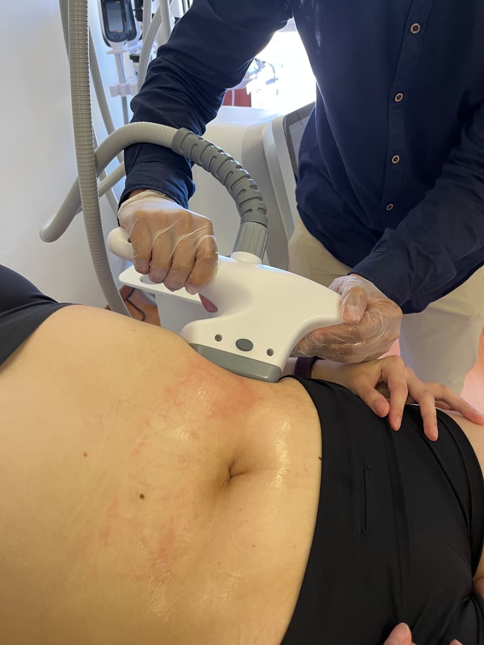 Velashape (5 sesiones)