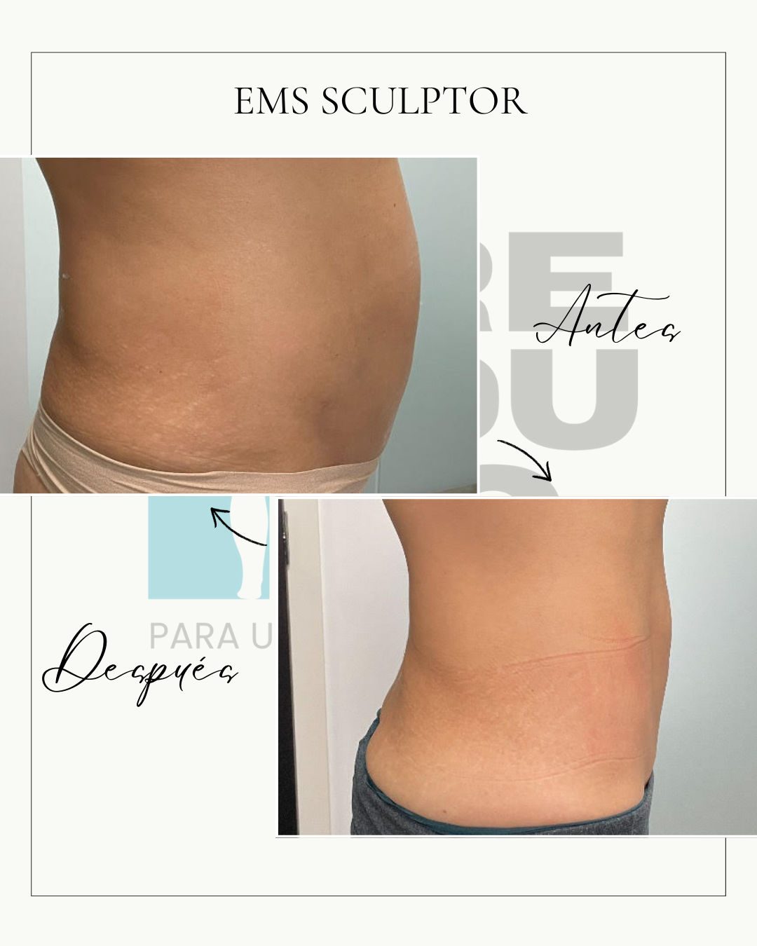 EMS Sculptor (5 sesiones)