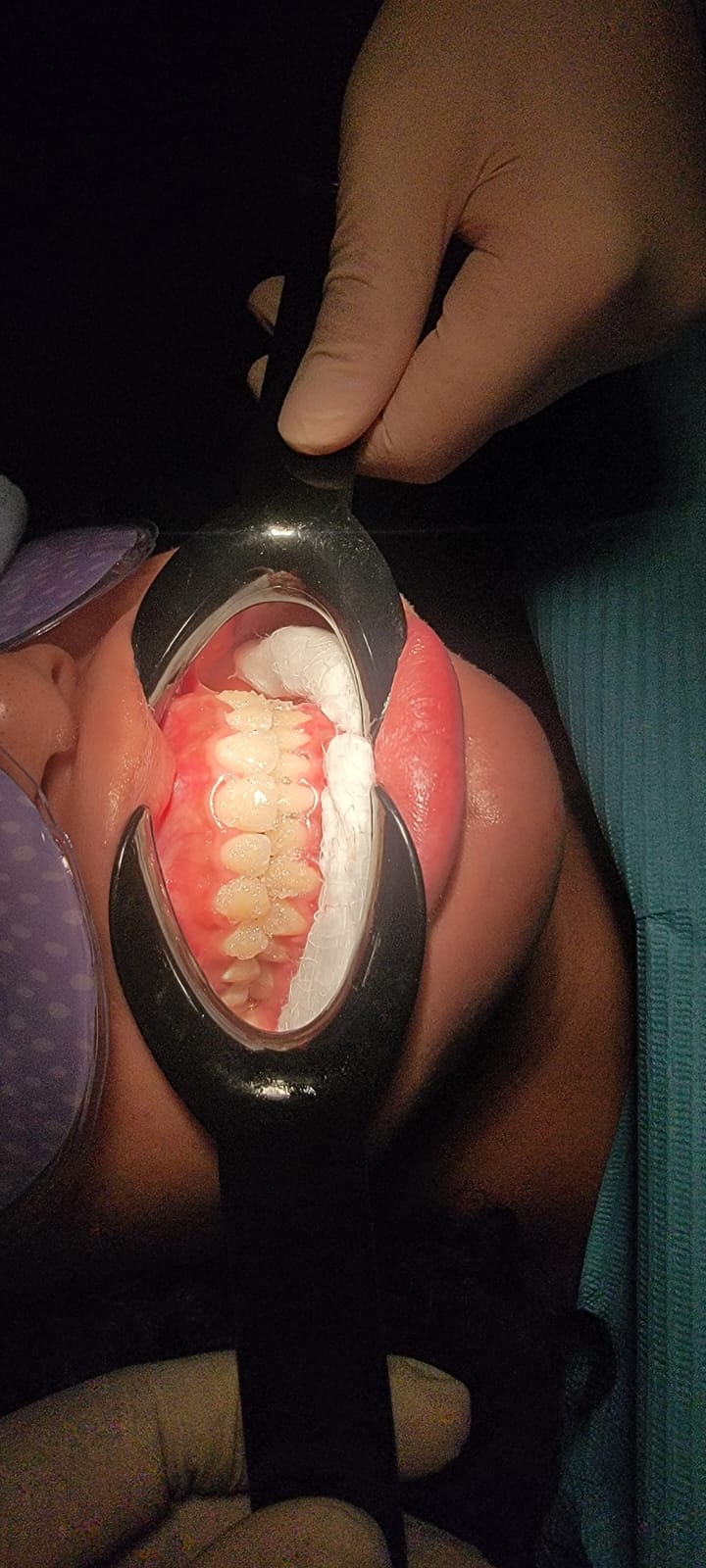 Dental Cleaning $500 - $800