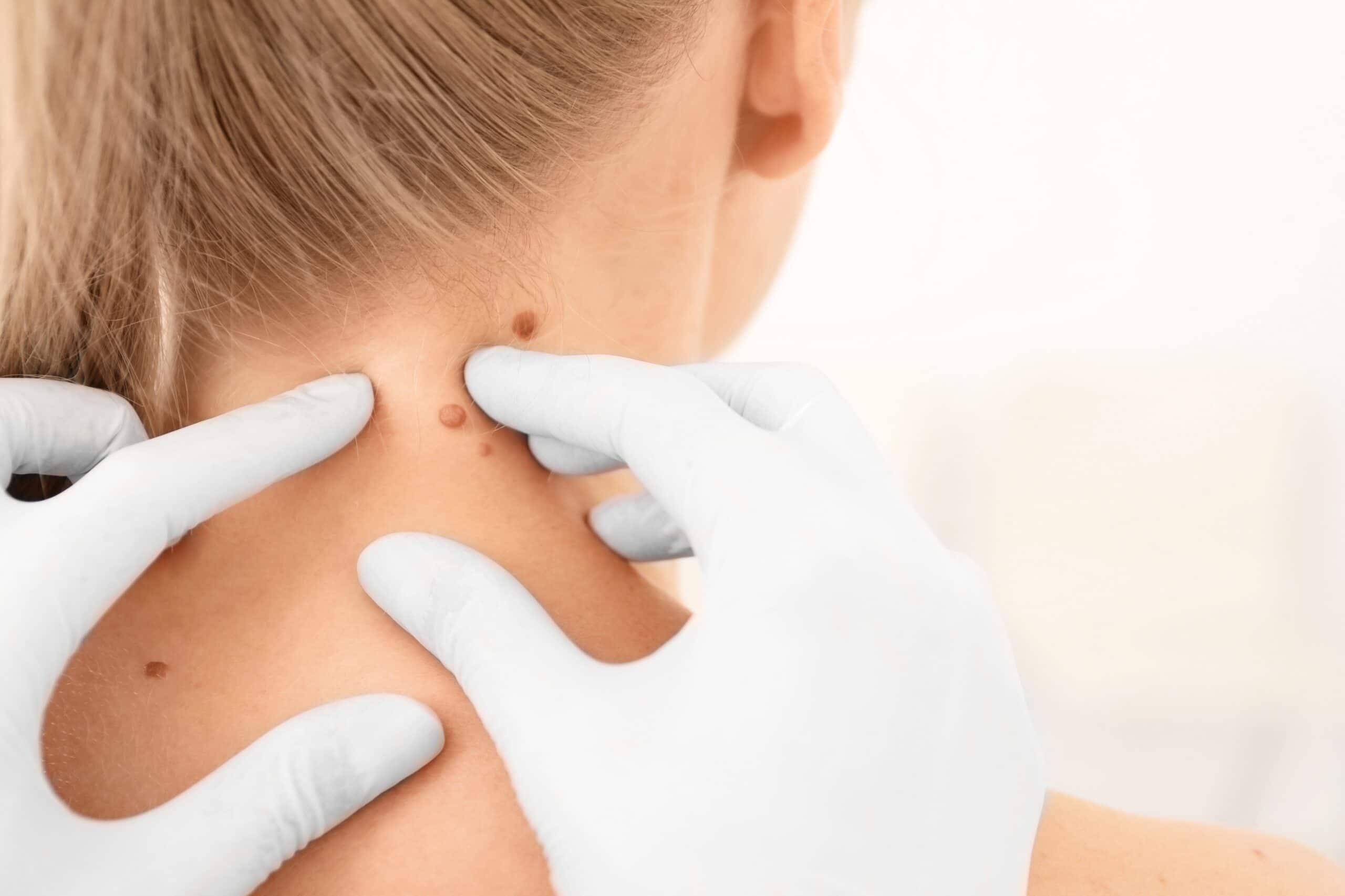 Eliminación de verrugas