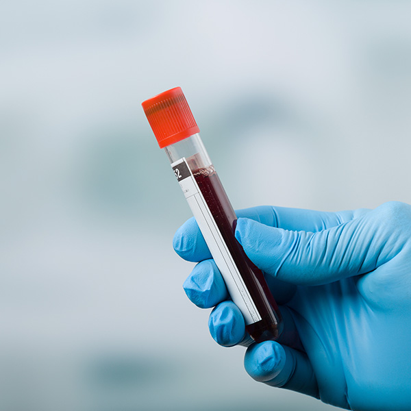 Inmunoglubolina G (IgG) anti-Strepotococcus pneumoniae DETERMINACIÓN