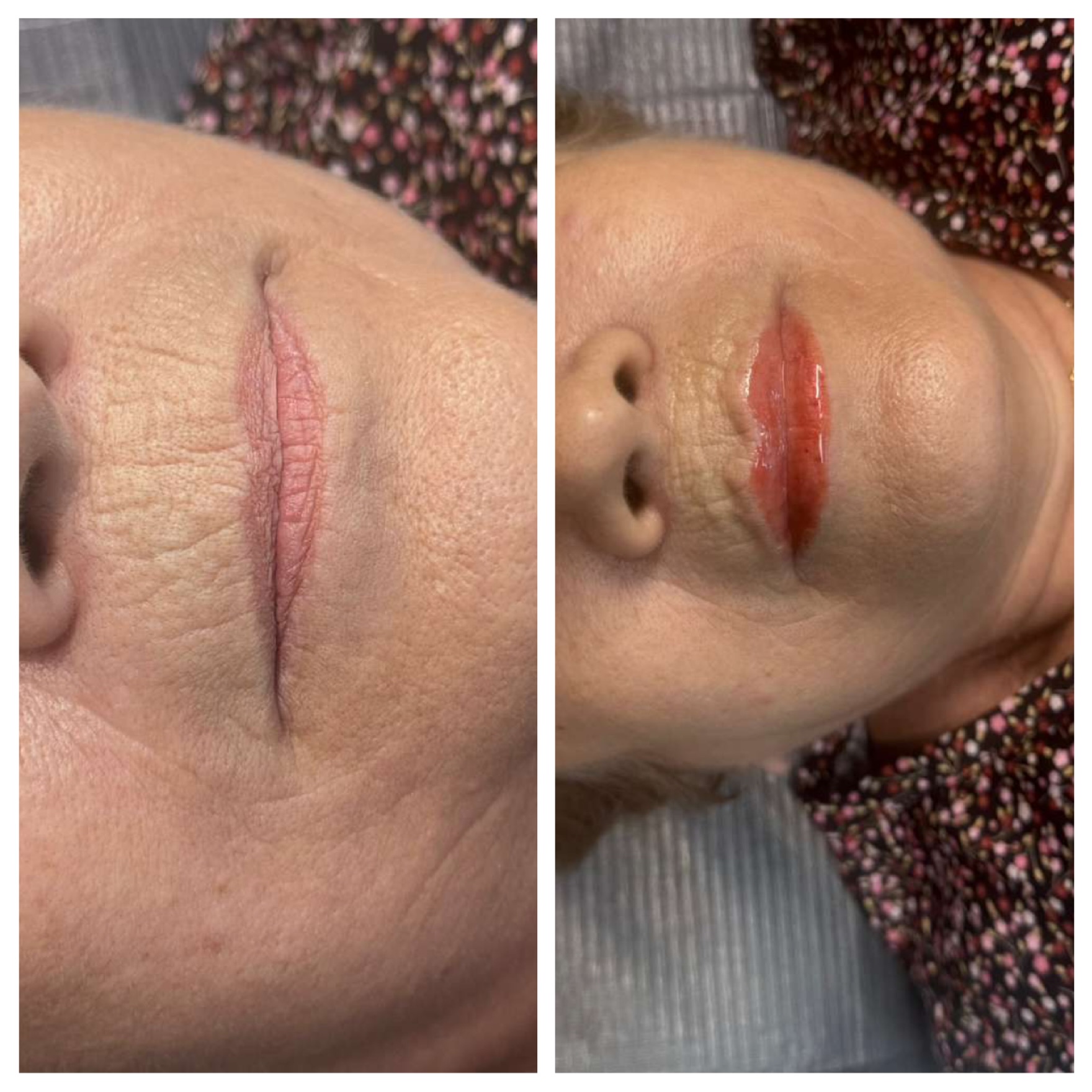 The HidraLips Treatment: $150