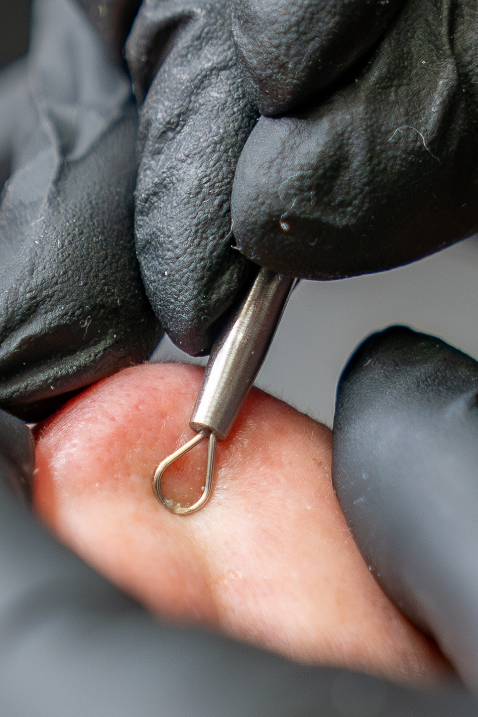 Skin Tag Removal (Acrocordones)