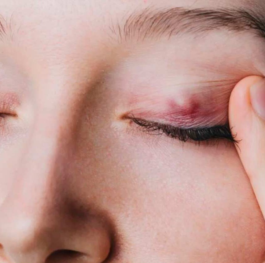 Cruetaje de chalazión