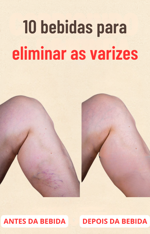 E-BOOK 10 BEBIDAS PARA ELIMINAR AS VARIZES