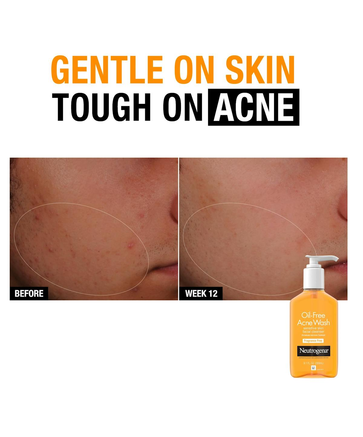 Neutrogena Oil-Free Acne Wash 9.1 oz – Fragrance Free