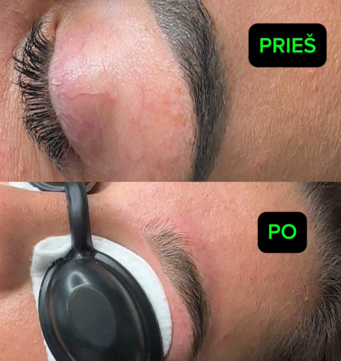 Tattoo ir PMU šalinimas lazeriu