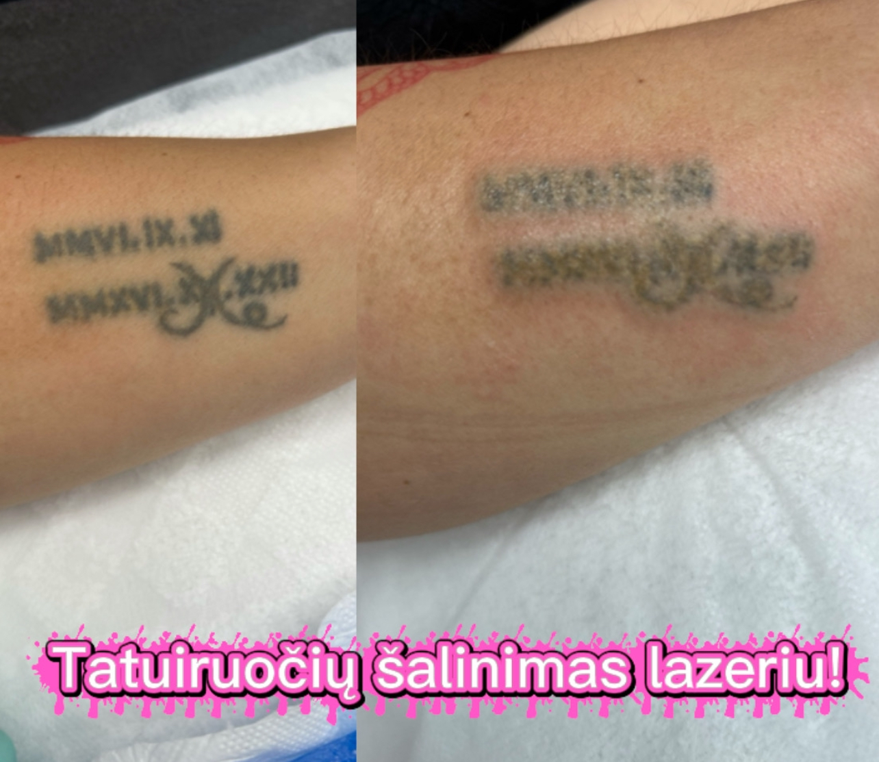 Tattoo ir PMU šalinimas lazeriu
