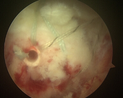 Artroscopia de hombro Reparación de mango rotador