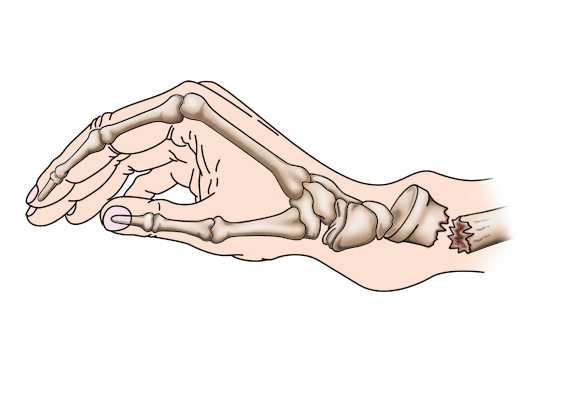 Paquete de Cirugía: Fractura de Radio Distal