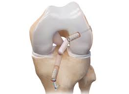 Reconstrucción De Ligamento Cruzado Anterior Por Artroscopia
