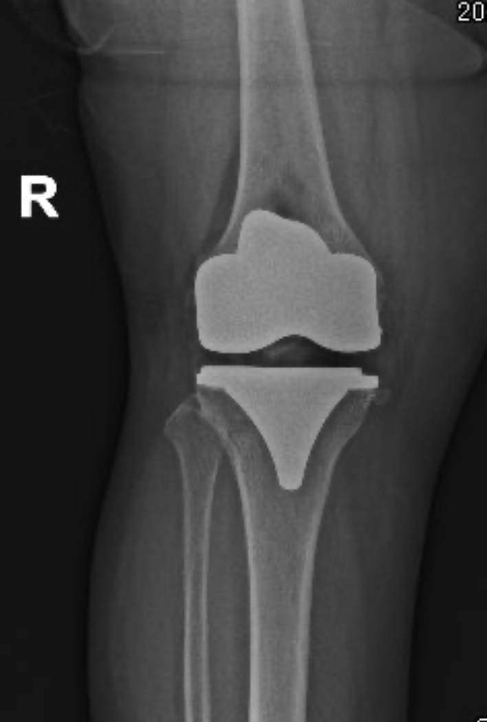 Prótesis Total De Rodilla