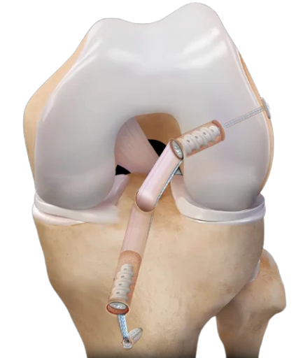 Reconstrucción De Ligamento Cruzado Anterior Por Artroscopia