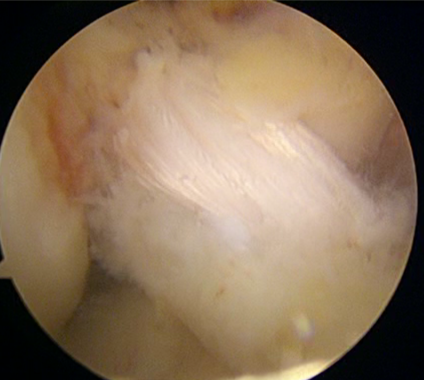 Reconstrucción De Ligamento Cruzado Anterior Por Artroscopia