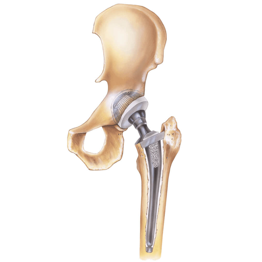 Prótesis Total De Cadera