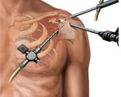 Artroscopia de hombro Reparación de mango rotador