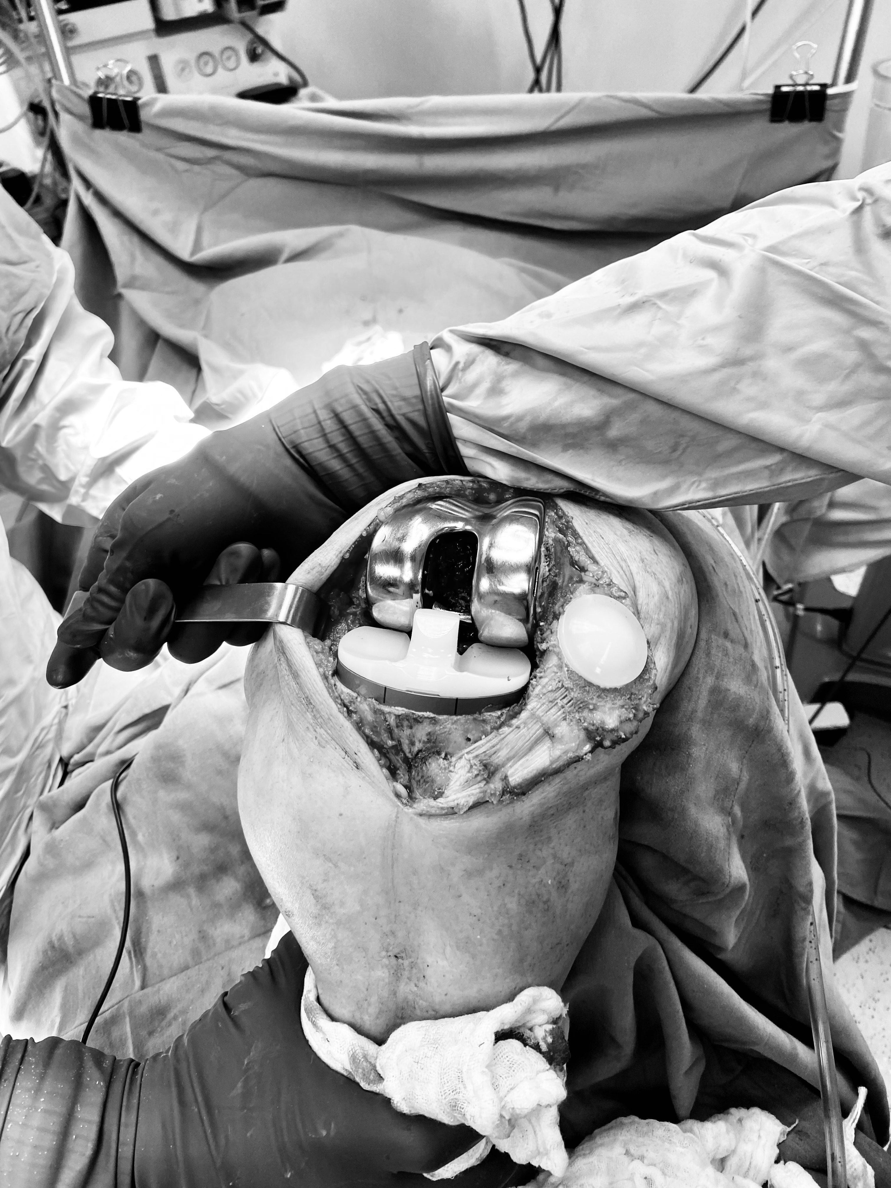 Prótesis Total De Rodilla